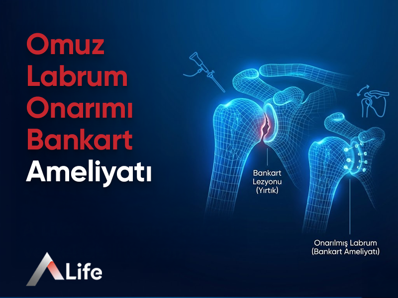 Omuz Labrum Onarımı Bankart Ameliyatı