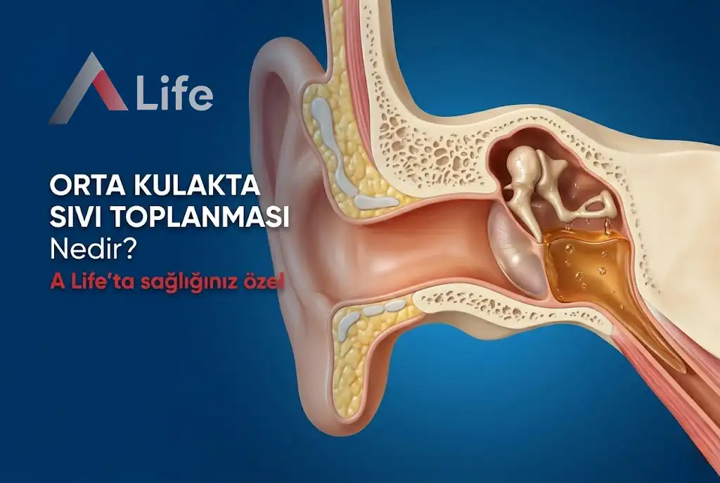 Orta Kulakta Sıvı Toplanması Nedir?