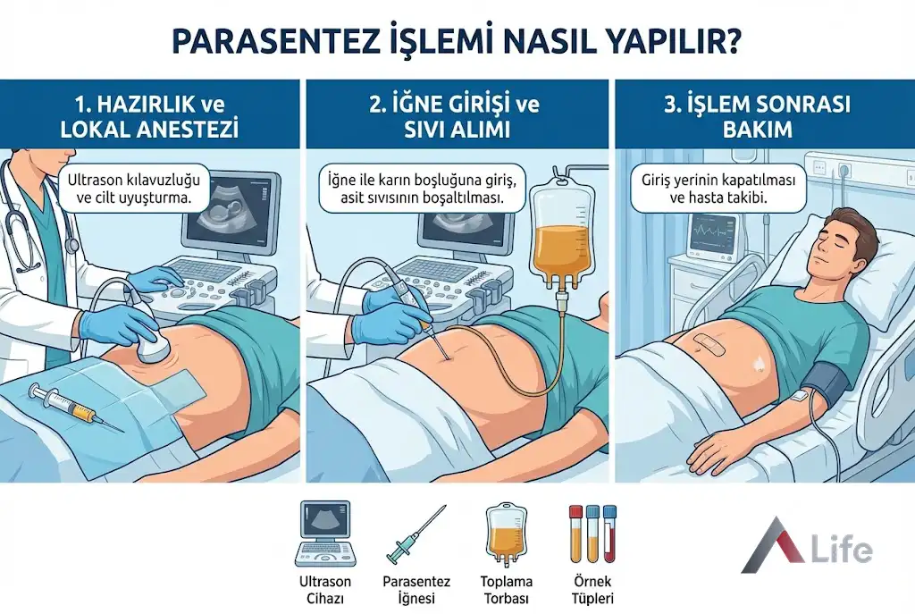 parasentez-nedir-karindan-sivi-alinmasi-islemi-a-life-ankara_1307ddb7.webp