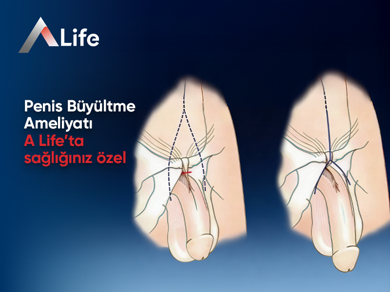 Penis Büyütme Ameliyatı