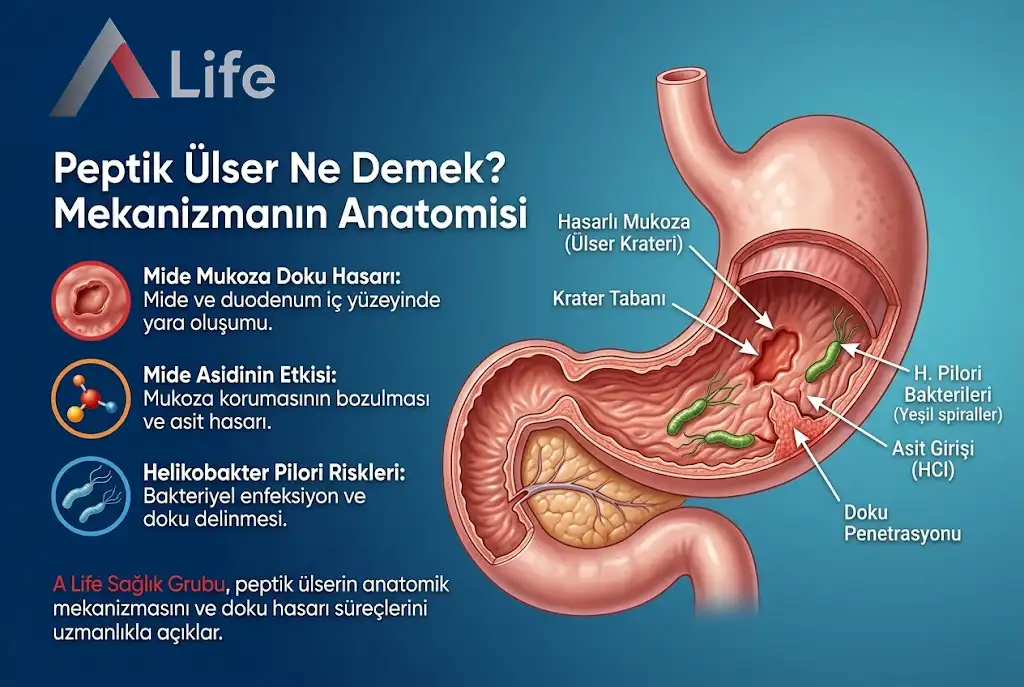peptik-ulser-ne-demek-a-life-ankara_c79961b0.webp