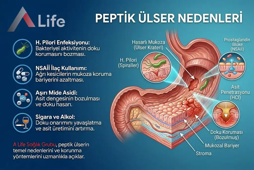 peptik-ulser-nedenleri-a-life-ankara_5ee632ea.webp