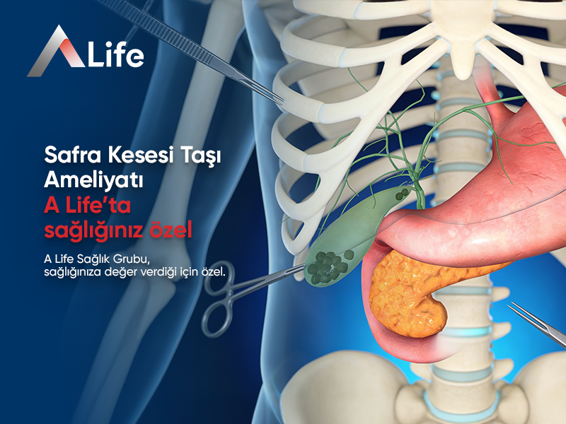 Safra Kesesi Taşı Ameliyatı