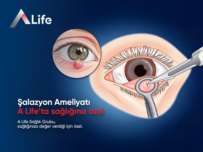 Şalazyon Ameliyatı