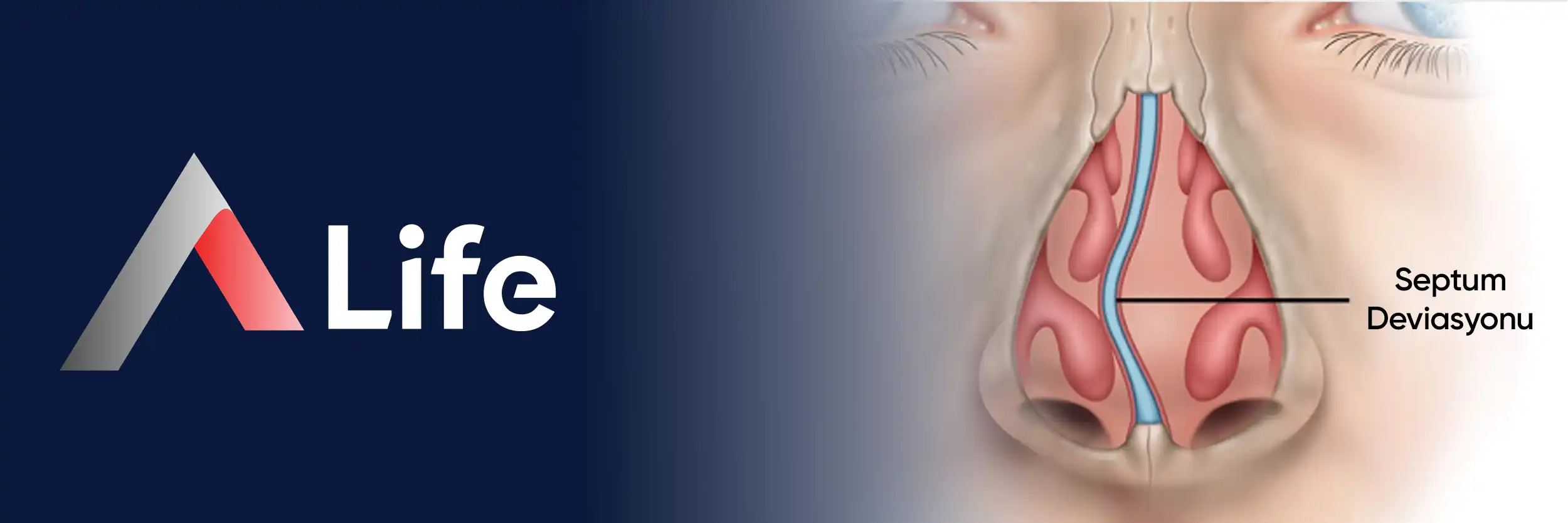 septum-deviasyonu_75d0410f.webp