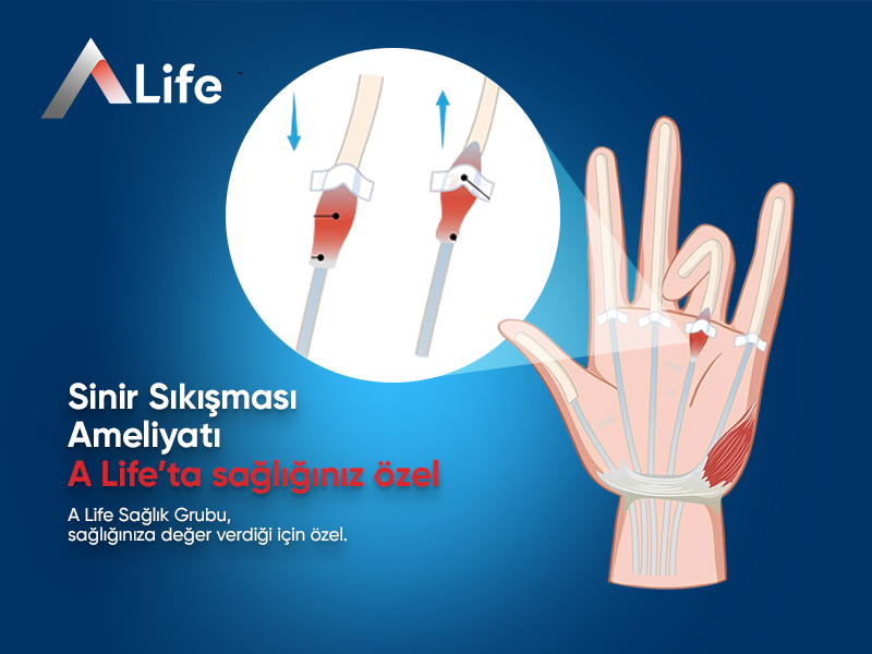 Sinir Sıkışması Ameliyatı