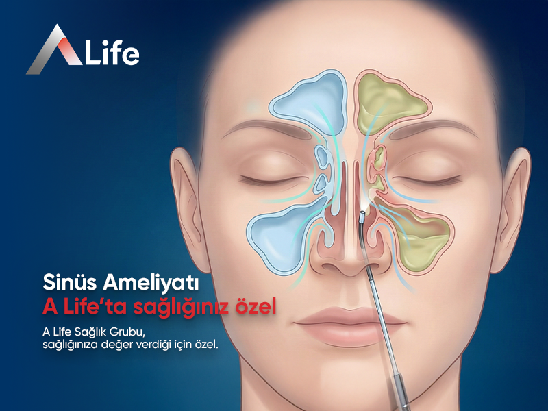 Sinüs Ameliyatı