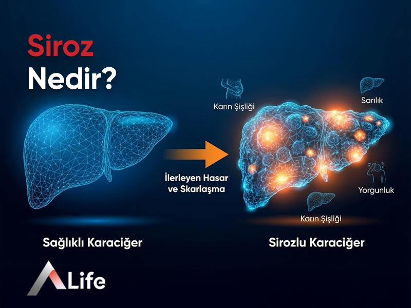 Siroz Belirtileri ve Tedavileri Nelerdir?