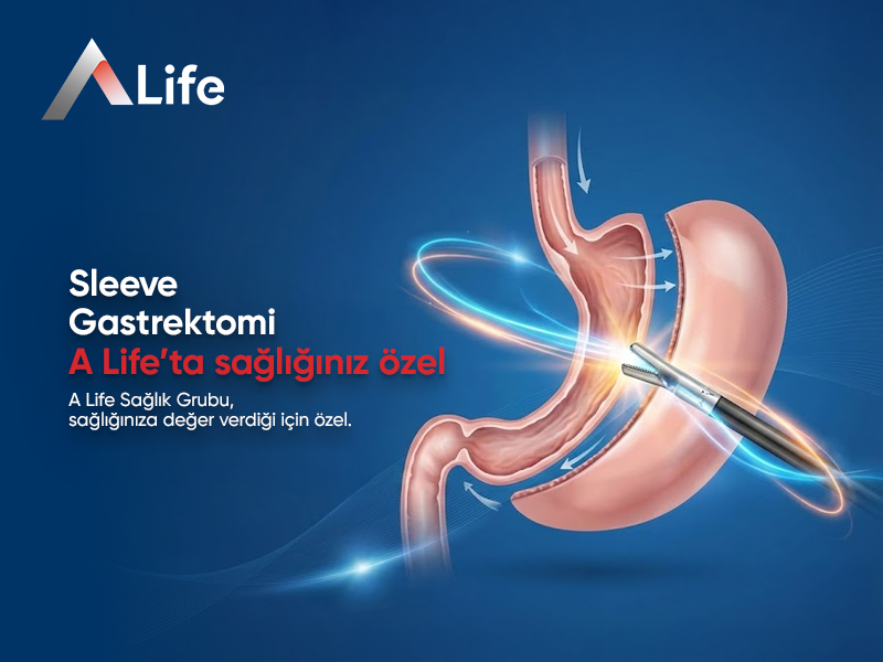 Sleeve Gastrektomi