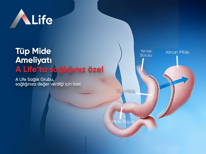 Tüp Mide Ameliyatı