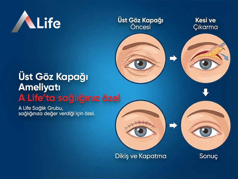 Üst Göz Kapağı Ameliyatı