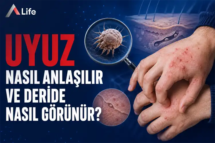 uyuz-nasil-anlasilir-ve-deride-nasil-gorunur_1b01a45c.webp
