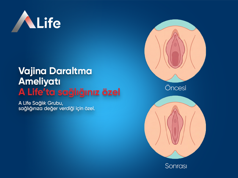 Vajina Daraltma Ameliyatı