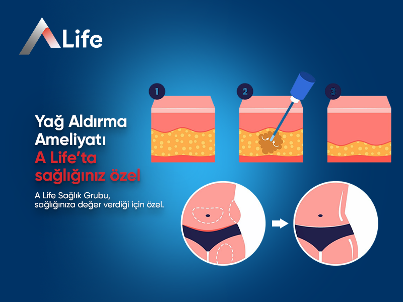 Yağ Aldırma Ameliyatı